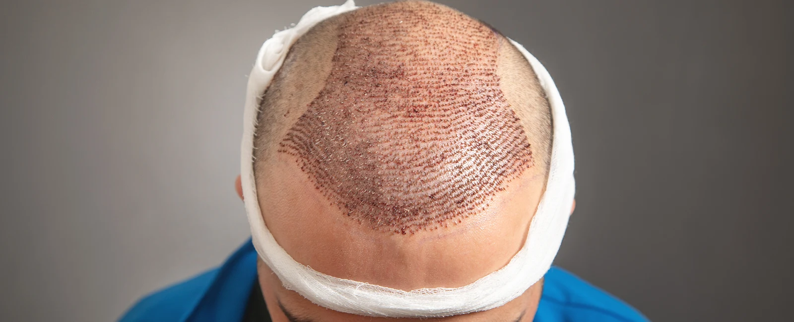 Implante capilar Cabello